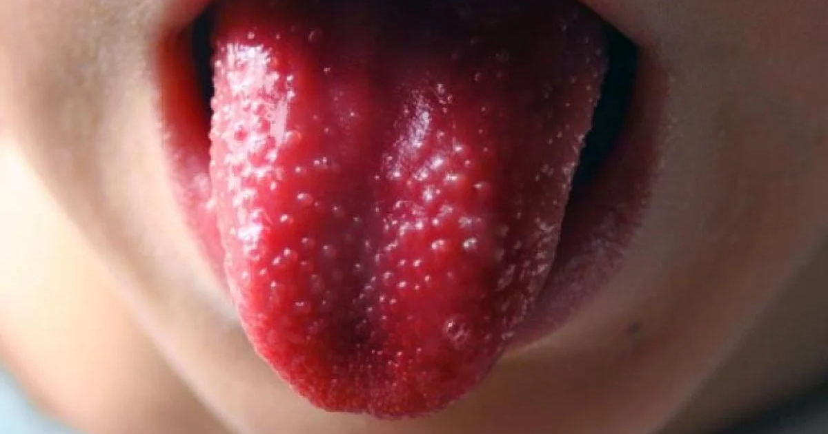 ¿Qué es la enfermedad de Kawasaki?